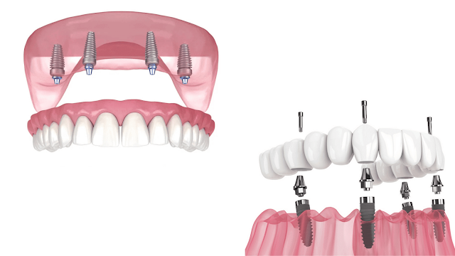 all-on-4-implants-dental-implants-review-barbies-beauty-bits