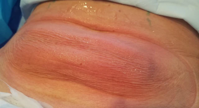 Coolsculpting before and afters by barbies beauty bits Coolsculpting before and afters by barbies beauty bits