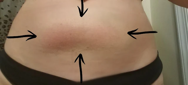 Paradoxical adipose hyperplasia casued from Coolsculpting by barbies Beauty Bits Paradoxical adipose hyperplasia casued from Coolsculpting by barbies Beauty Bits