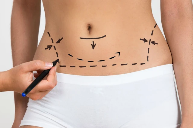 liposuction vs coolsculpting by Barbies Beauty Bits liposuction vs coolsculpting by Barbies Beauty Bits