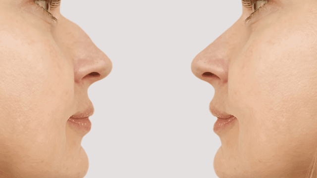 rhinoplasty-recovery-barbies-beauty-bits rhinoplasty-recovery-barbies-beauty-bits