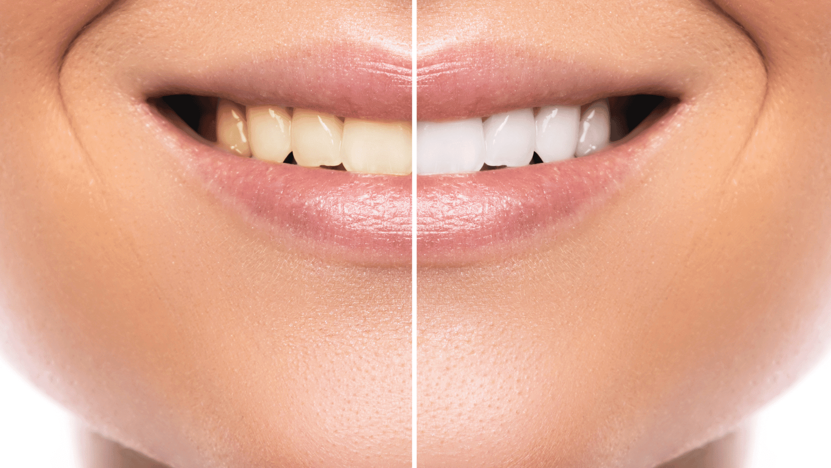 teeth-whitening-options-which-one-is-right-for-you-barbies-beauty-bits