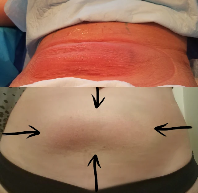 The bad side affects of coolsculpting by barbies beauty bits.jpg The bad side affects of coolsculpting by barbies beauty bits.jpg